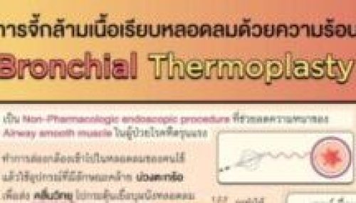 13.การจี้กล้ามเนื้อเรียบหลอดลมด้วยความร้อ
